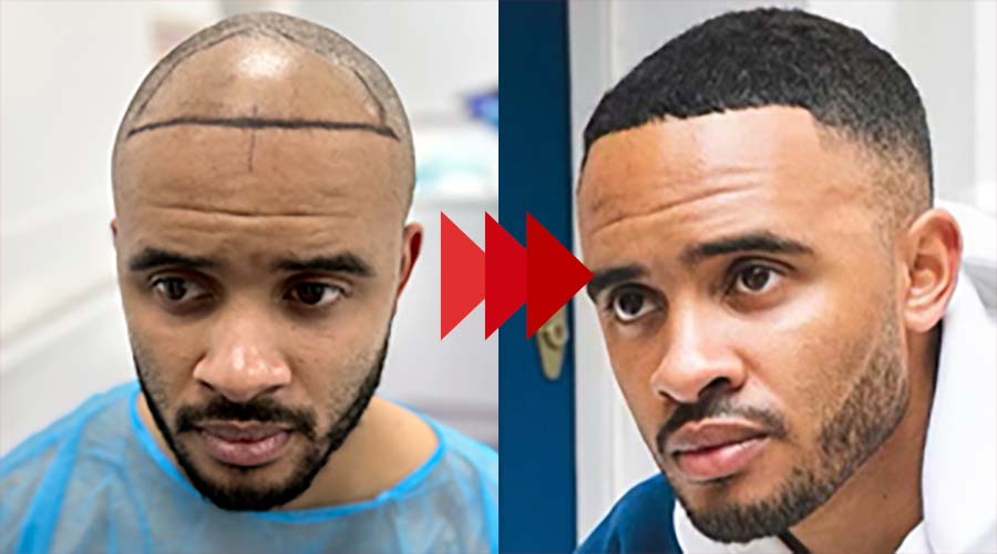 Afro Hair Transplant Results