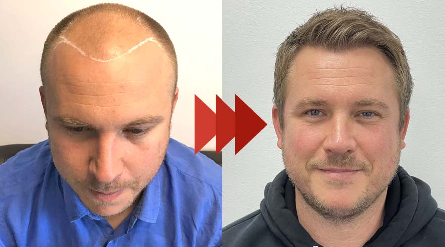 Men's Hair Transplant Results