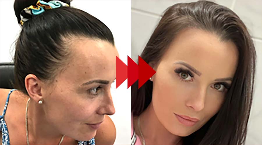 Women's Hair Transplant Results