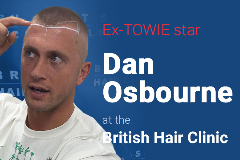 Dan Osbourne - British Hair Clinic - Hair Transplant