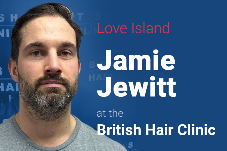 Jamie Jewitt - British Hair Clinic - Hair Transplant
