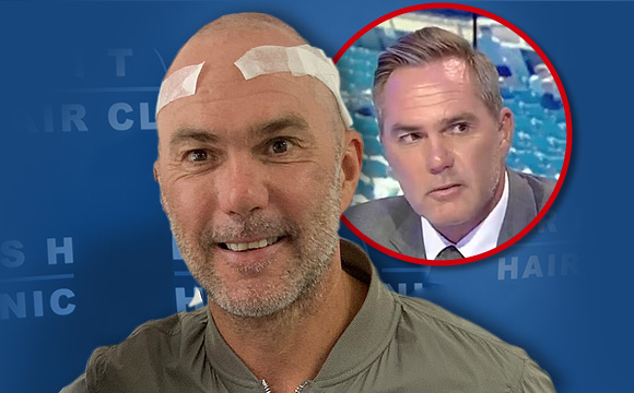 British Hair Clinic - Jason Mcateer Hair Transplant