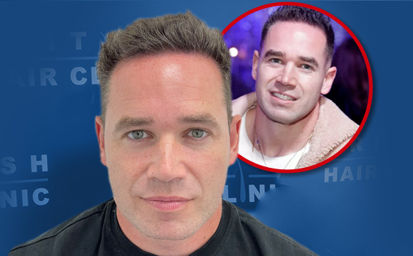 British Hair Clinic - Kieran Hayler Hair Transplant